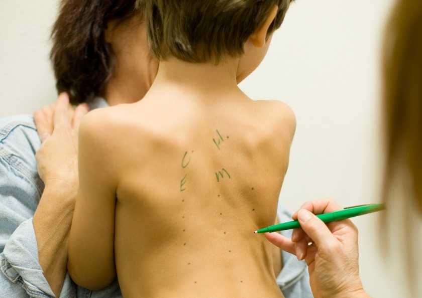 Cilt Prick Testi mi Kan Testi mi Hangi Alerji Testi Daha Etkili