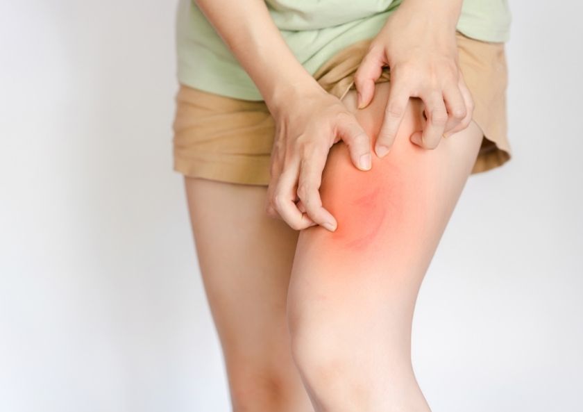 Alerjide Çapraz Reaksiyon Nedir