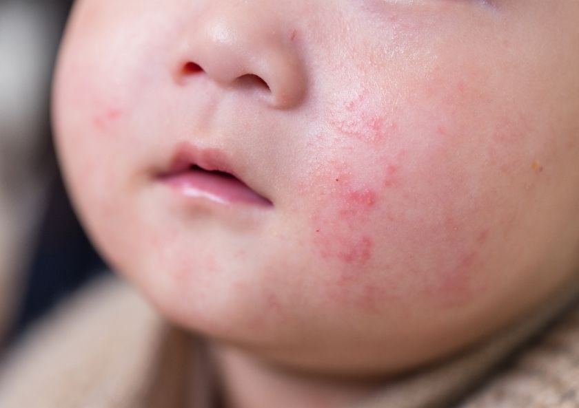 Bebeklikte Egzama Gelecekte Alerji ve Astım Habercisi mi