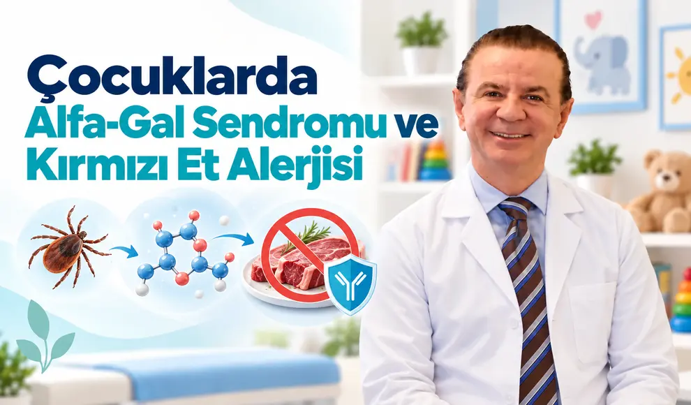 Çocuklarda Alfa-Gal Sendromu ve Kırmızı Et Alerjisi